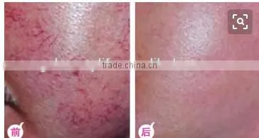 Factory directly sale vascular removal machine for salon use/ Clinic use spider remove machine