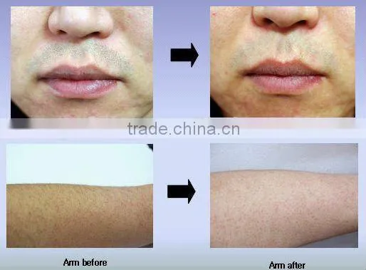 mikrotubuler diode bar/808nm diode laser hair removal