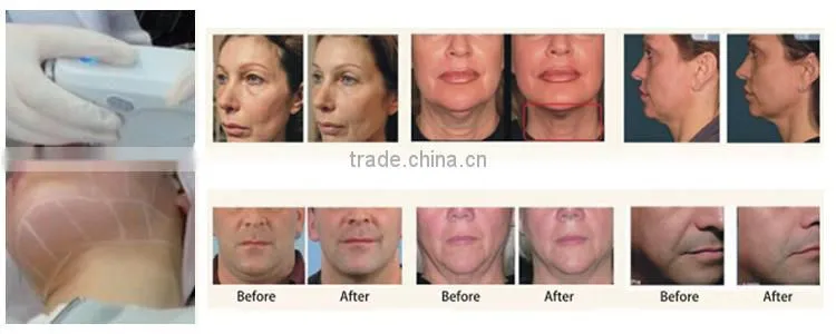The most popular international portable hifu face lift beauty treatment machine at home