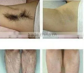ipl machine photo skin rejuvenation