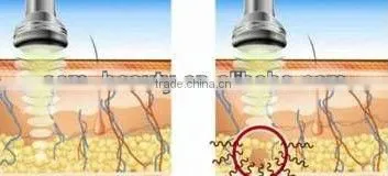 Low cost !!ultrasonic liposuction cavitation rf slimming machine with CE approval