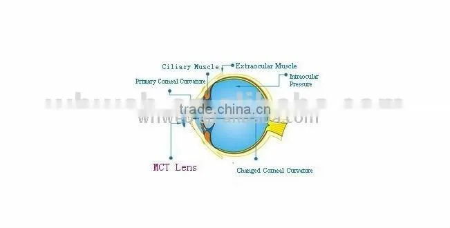 Medical care Digital Professional Lens (ortho-k:MCT)/RGP/