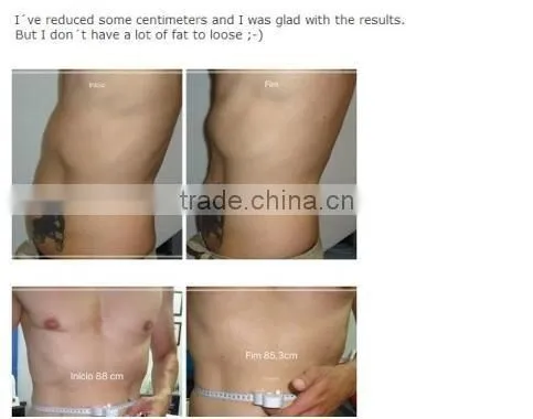 HIFU ultrasonic slimming machine for body shaping and reducing striae of pregnancy