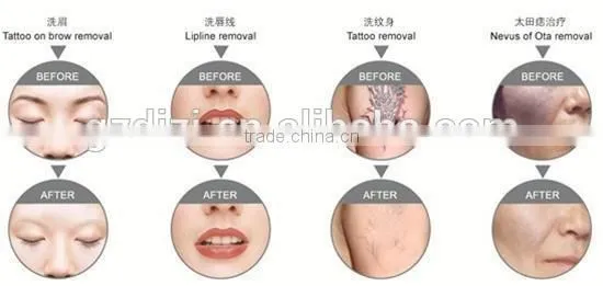 High quality factory price best laser tattoo removal machine