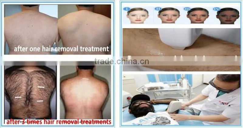 Professional Painless laser de diodo depilacion