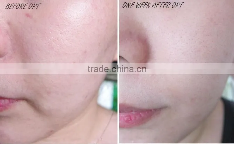 best quality portable ipl machine /e-light ipl machine ce approved with 100000shots lamp life