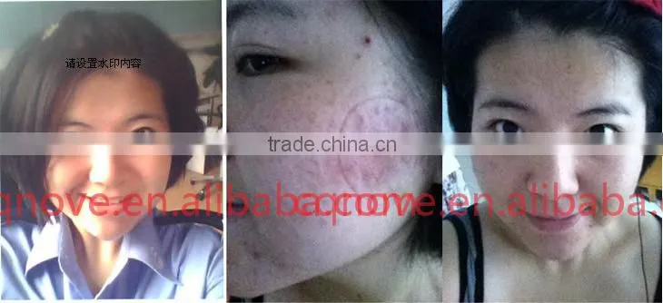 Top quality anti aging PDT photodynamic red light therapy for wrinkles