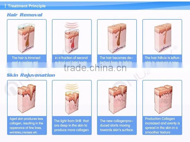 Body Hair removal device 3000W Input Power Semiconductor +water+air cooling system ipl hair removal machine