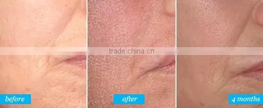 Acne Treatment Skin Rejuvenation Skin Tightening er yag laser scar CO2 laser