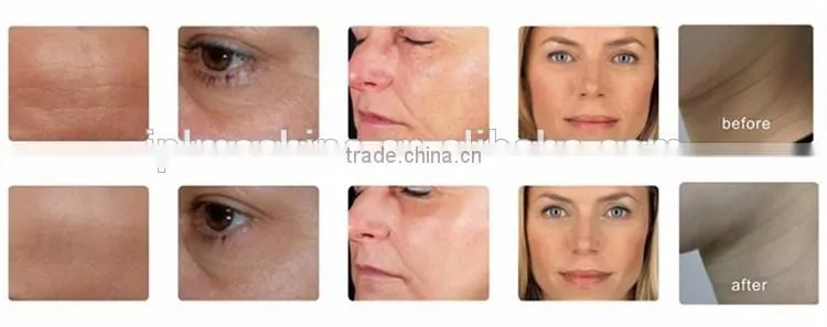 Hot selling rf fractional