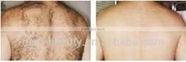 hot distribution professional 2000 w beauty equipment hair removal ipl shr laser