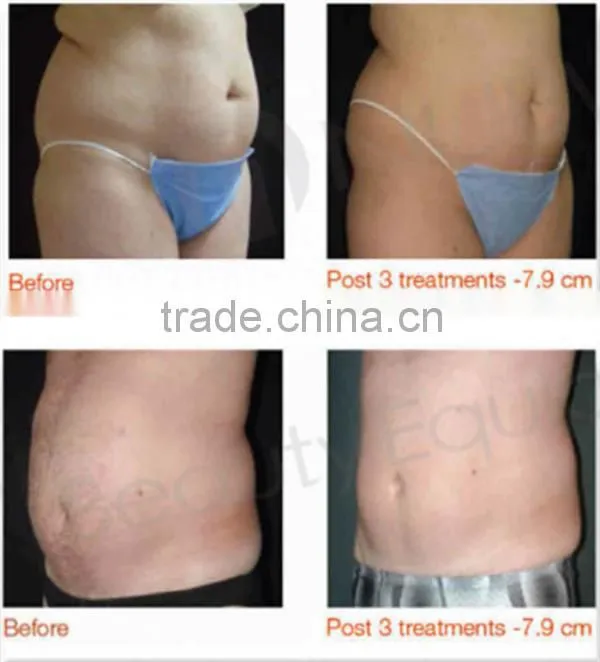 HIFU Body Fat Slimming! Professional Hifushape machine personal body care new hifu