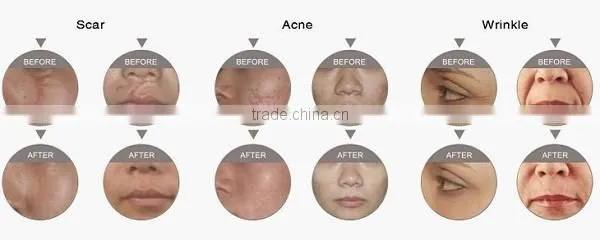 Beauty equipment Chinese manufacturer RF co2 fractional laser for scar wrinkle removal