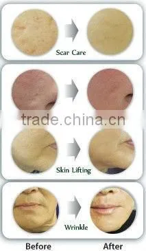 Good quality medical stainless material needles derma roller dermaroller