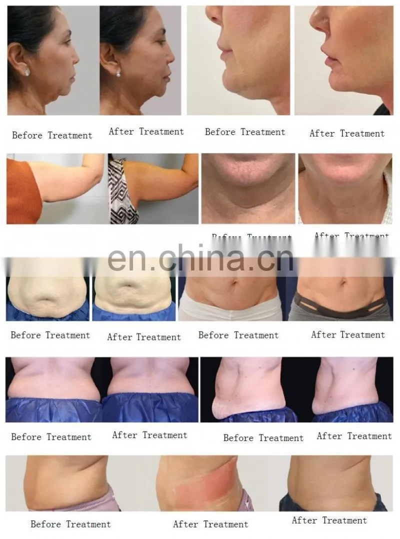 2022 Hot 2mhz Monopolar Rf Slimming Trusculpt Id Cellulite Treatment Fat Dissolve Machine