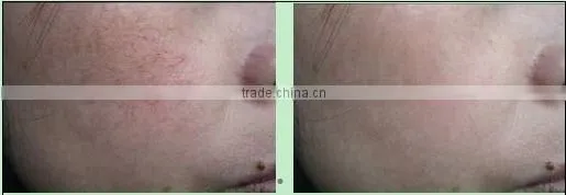 High frequency new viewer rbs spider veins removal vascular laser treatment machine