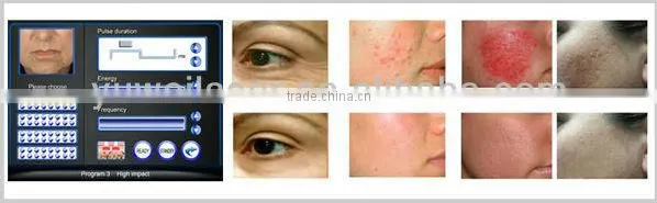 Scar removal fractional co2 laser equipment
