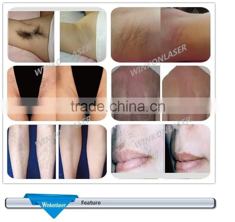 world best hair removal equipment / women underarm hair removal machine / eraser hair remover