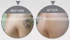 colored tattoo removal and Pigment deposit dispelling 585nm pulsed dye laser machine