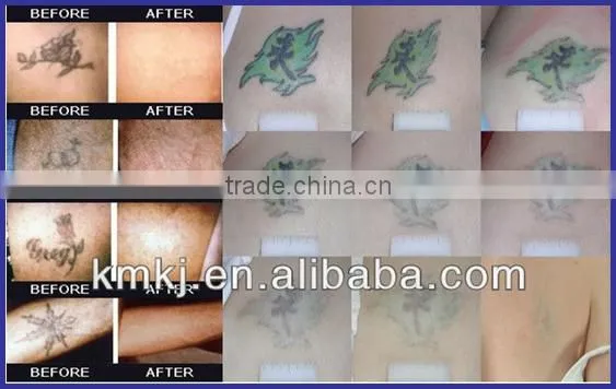 2016 New IPL Nd Yag Laser/SHR laser hair removal tattoo removal 2 in 1 beauty machine