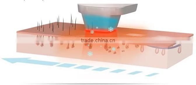 IPL SHR Laser Hair Removal Machine For Sale / ipl laser machine for sale