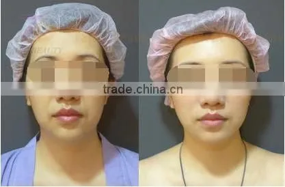 spa wanted best selling of skin lightening and whitening machine with diamond dermabrasion