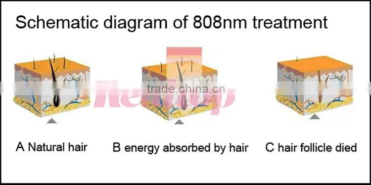 Our company want distributor diodo laser 808nm depilazione,speed 808 diode laser hair removal made in China