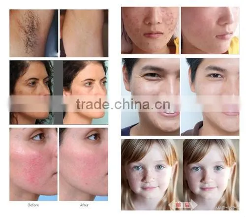 beauty salon used machine:ipl elight skin tag/ skin mole removal machine C006