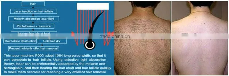 Perfect nd yag laser professional remove hair safe to dark skin
