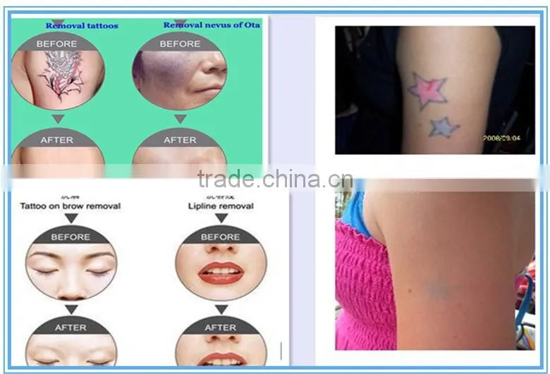 cheap q switch nd yag tattoo removal laser machine with top quality and medical ce approval