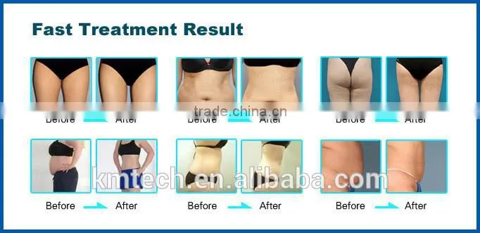 Hot selling new design radio frequency system cavitation cellulite system