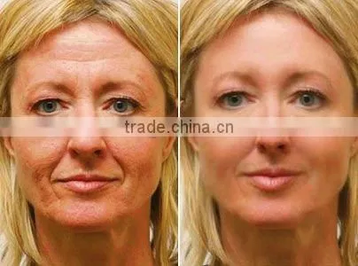 microneedle therapy system derma stamp titanium for eye wrinkle treatment SRS-9