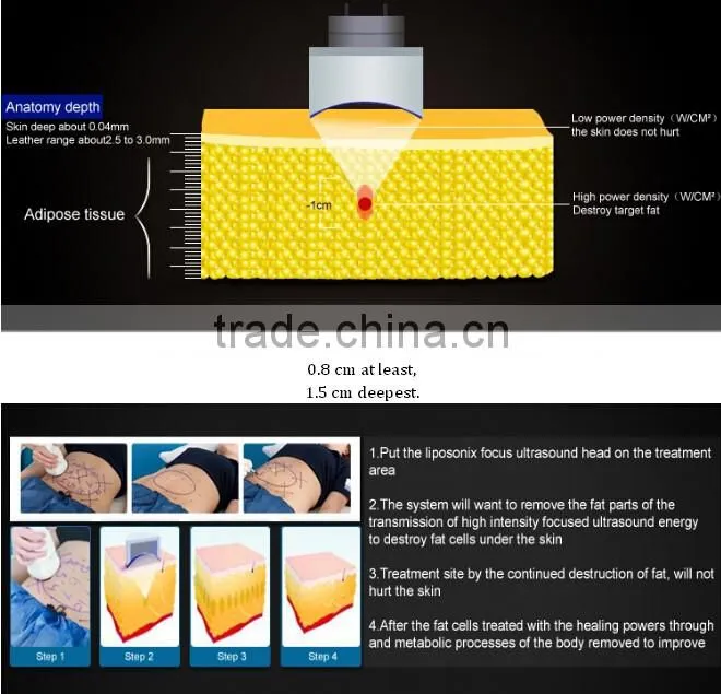 2016 New Liposonix HIFU body slimming weight loss beauty salon equipment