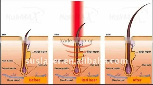BL002 Hair Loss Treatment PDT LED Light Therapy For Hair Loss Treatment