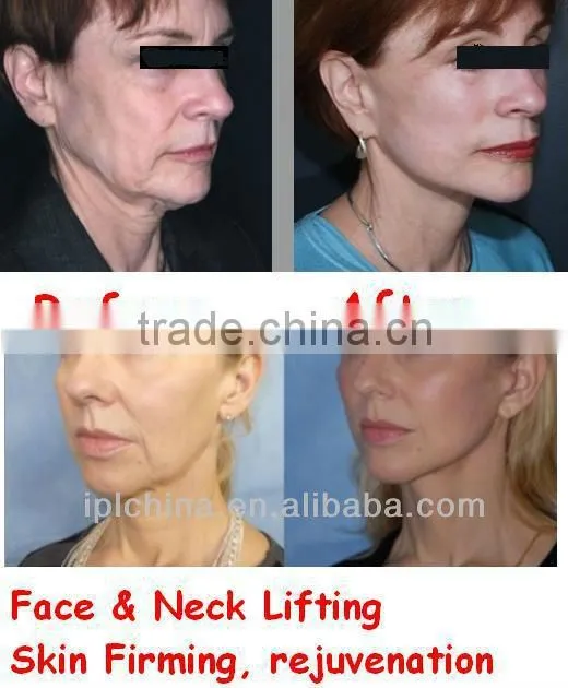 RF oxygen jet skin care cosmetics(Oxy Megastation)