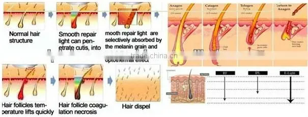 Christmas promotion! Factory price ipl omni laser