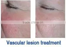 2015 Newest multifunctional cosmetic equipment ipl hair removal germany skin solution