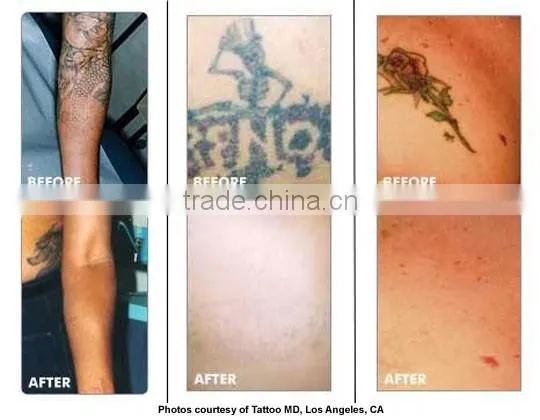 2016 Hottest Home Laser tattoo removal q switch nd yag laser-vascular