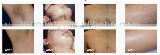 10.000.000 shot full body laser hair removal