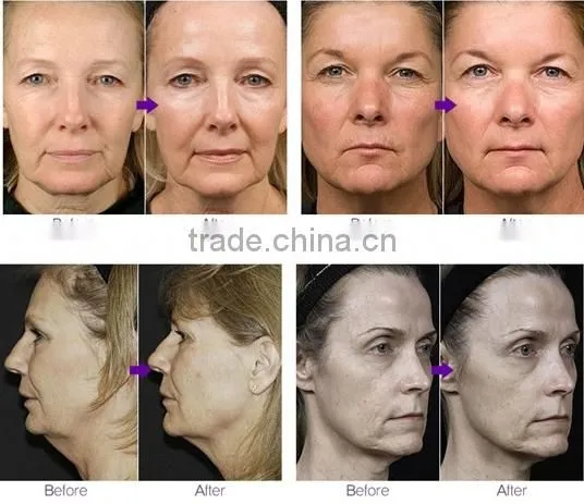 New Hot Invasive Micro Needle Radio Frequency Facial Machine