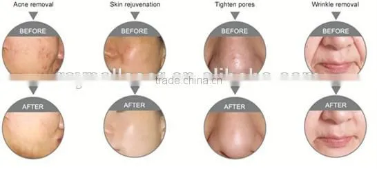 Treading hot products for skin care professional rf physical therapy machine