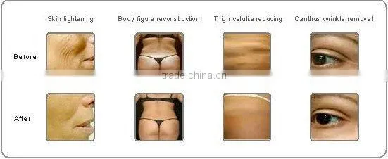 Promotion home skin care device cavitation rf machine