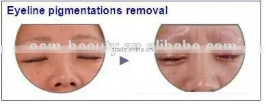Newest laser tattoo removal machine permanent and pain free tattoo removal
