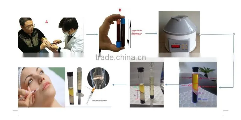 High concentration platelet rich plasma PRP tube