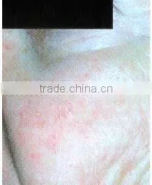 Excellent portable red vascular laser treatment