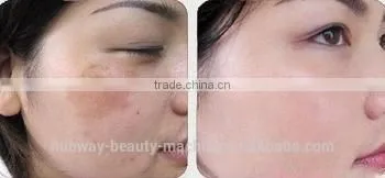 Best Quality Laser Hair Removal Machine IPL Laser Skin Rejuvenation IPL Machine Made In Germany