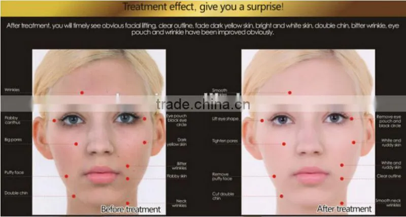 2015 The Newest High reflective laser skin treatment machine