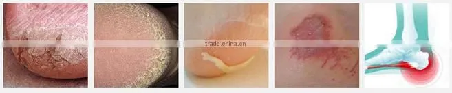 2016 hot sell Breathable and cushion Silicone Gel Heel pad and Ankle Sleeve for Plantar Fasciitis