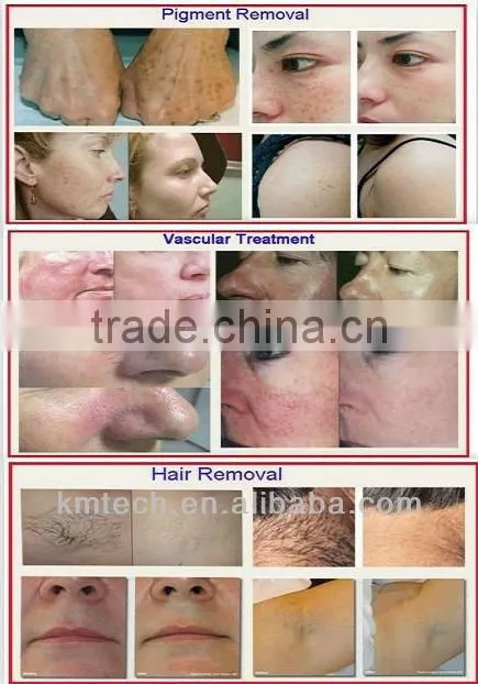 Month sale 100 units! factory outlets and high power stretch mark removal beauty machine