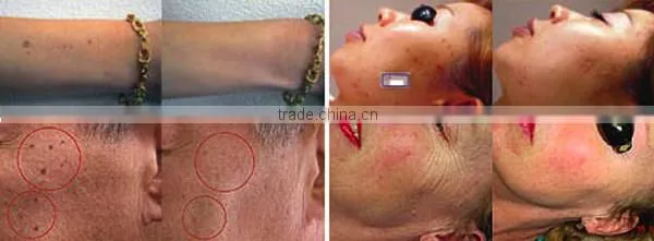 Best Elight IPL RF 3H photo rejuvenation machine